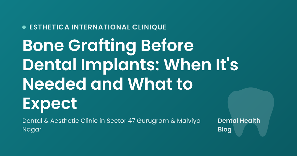 Bone Grafting Before Dental Implants: When It's Needed and What to Expect