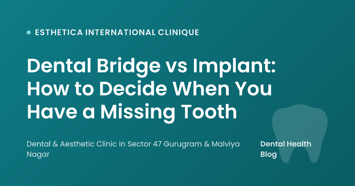 Dental Bridge vs Implant: How to Decide When You Have a Missing Tooth