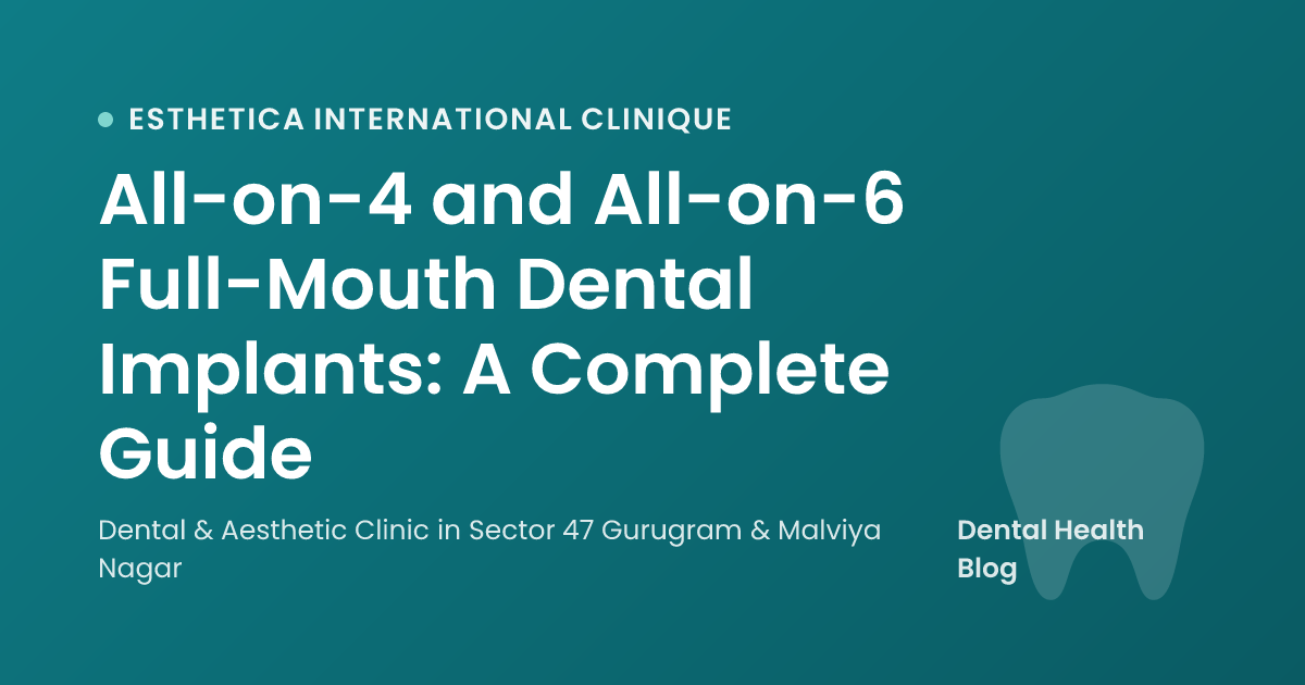 All-on-4 and All-on-6 Full-Mouth Dental Implants: A Complete Guide
