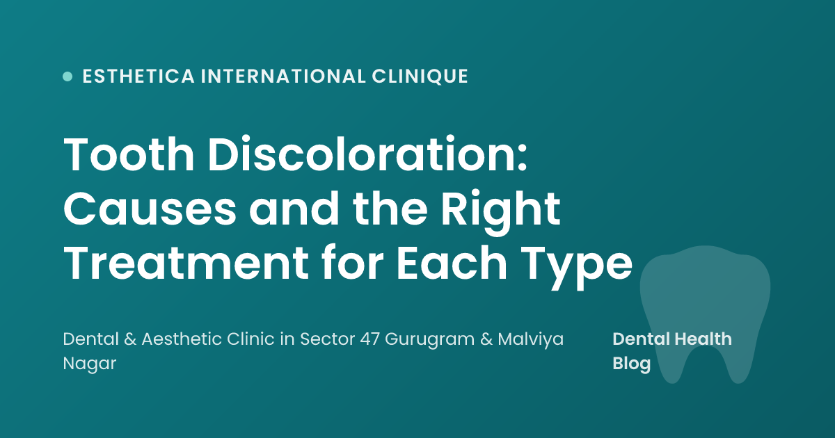 Tooth Discoloration: Causes and the Right Treatment for Each Type